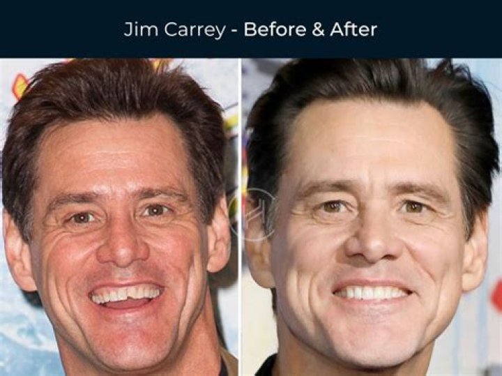 
What Is Wrong With Marvin Vettori Teeth? Before And After Photo 